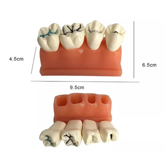 Моделювання зубів для ущільнення ям і тріщин для навчання