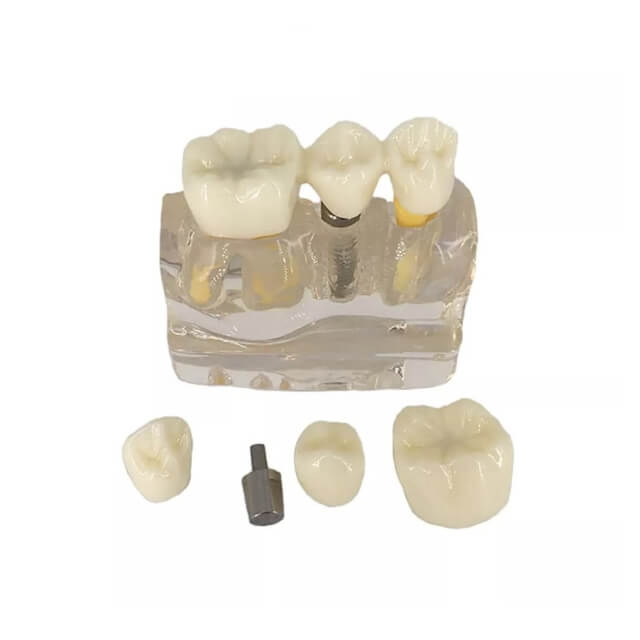 Стоматологічна модель імплантату зуба