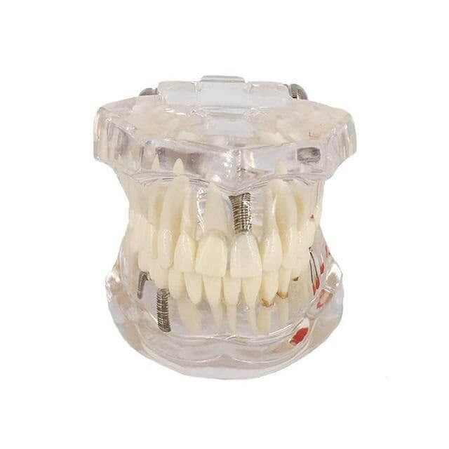 Модель зубного імпланту для стоматолога